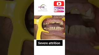 Management of severe attrition With Capping of teeth [upl. by Bate]