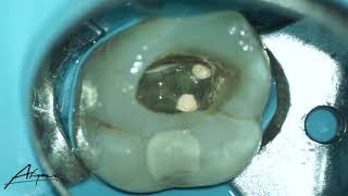 Obturation phase of the root canal treatment of maxillary second molar [upl. by Draper736]