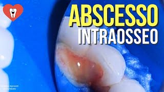 URGÊNCIA ENDODONTIA NEM PENSE EM USAR ANTIBIÓTICO AQUI  Endolovers [upl. by Ikceb]