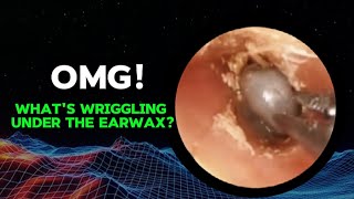 Horrifying  Insects combine with earwax to block the ear canal [upl. by Ednihek]