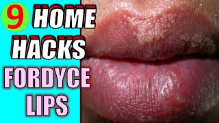 How to Get Rid of Fordyce Spots at Home Quickly  9 Home Remedies for Fordyce Spots on Lips [upl. by Nalym]