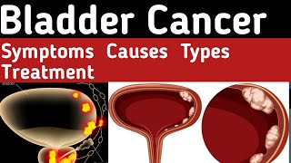 Bladder Cancer Types What causes bladder cancer Bladder Cancer Symptoms Bladder Cancer Treatment [upl. by Anaeerb]