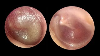 Impacted Ear Wax RemovalEP6  NN Ear cleaning [upl. by Aiyn]