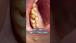 Root canal treatment procedure  upper molar root canal viral dentist [upl. by Ydnes]