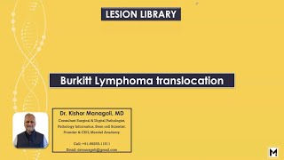 Pathology of Burkitt Lymphoma Translocation [upl. by Peri]