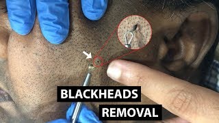 Blackheads  Whiteheads Extraction  ZI Clinic [upl. by Kella]