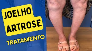 ARTROSE JOELHO  tratamento acupuntura fisioterapia [upl. by Ardet]