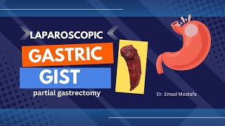 gastric GIST laparoscopic partial gastrectomy [upl. by Atnauqahs]