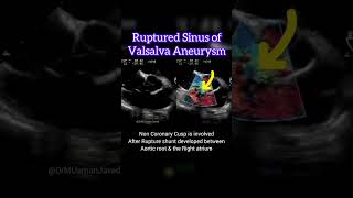 Ruptured Sinus of Valsalva Aneurysm echocardiography echocardiogram cardiology lcx [upl. by Henghold]