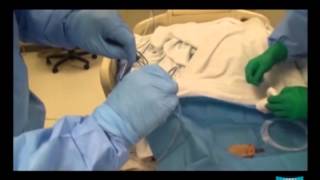 Percutaneous Endoscopic Gastrostomy pull method and Jejunal Extension Tube Placement [upl. by Azarcon286]