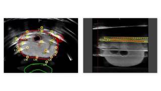 Realtime Prostate Solutions for treating prostate cancer with brachytherapy [upl. by Adolph]