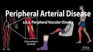 Peripheral artery disease Pathophysiology Causes Symptoms Diagnosis and Treatments Animation [upl. by Evilc]