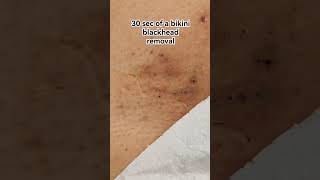 Lets get this ingrown blackhead out of the Way pimple satisfying blackheads skincare ingrown [upl. by Anirahc993]