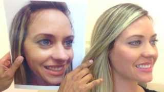 Botox amp Restylane Before amp After [upl. by Eynenihc]