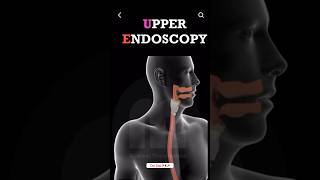 Endoscopy of stomach Stomach Ulcers endoscopy stomach ulcers shorts medical trending viral [upl. by Akiner]