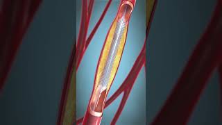 procedure of angioplasty shorts viralshorts [upl. by Aden]