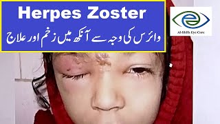 Herpes Zoster Ophthalmicus Symptoms and Treatment  UrduHindi [upl. by Jordans]