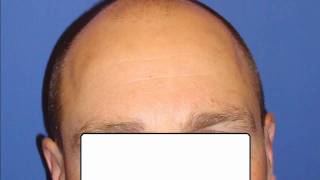 Hair restoration for balding frontal area [upl. by Erdnuaed]