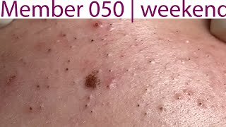 Acne Treatment Huong Da Nang 050  weekend  2023 [upl. by Amanda454]