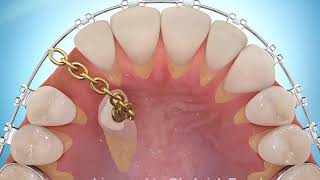 Impacted Cuspid Palatal Treated [upl. by Reddin]