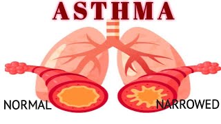 ASTHMA  DEFINITION  CAUSES  PATHOPHYSIOLOGY SYMPTOMS  TREATMENT BSc GNM [upl. by Berkie]