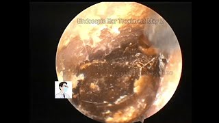 Ear wax removalCommon cerumen embolic processing [upl. by Iruahs]