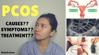 PCOS  Causes Symptoms Treatment  Tagalog [upl. by Aitropal2]