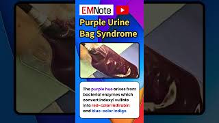 Purple Urine Bag Syndrome nursing doctor medical [upl. by Ellah]