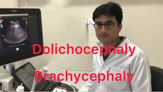 Sonography Dolichocephaly and Brachycephaly [upl. by Rains357]