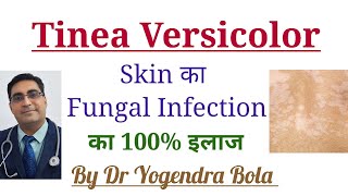 Tinea Versicolor Skin Infection ka 100 Treatment [upl. by Ellehcen]