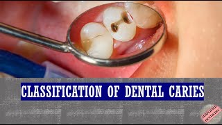 Classification of Dental Caries [upl. by Aggarwal]