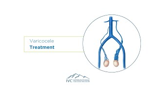 Varicocele Treatment  Embolization [upl. by Markowitz]