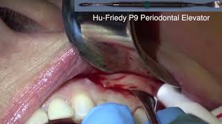 Apicoectomy of maxillary first molar [upl. by Akeem]