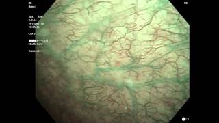 interstitial cystitis 間質性膀胱炎 6回目 膀胱鏡 [upl. by Aicre]