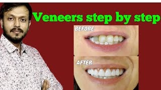 Veneers from start to end  Veneers Treatment  Veneers teeth before and after [upl. by Rennoc644]