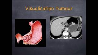 Cancer de lestomac [upl. by Hulton]