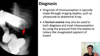 Intussusception Explained A Comprehensive Guide for Nursing and Midwifery Students [upl. by Lili]