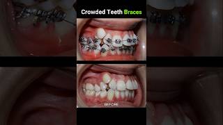 40 months for this braces Crowded teeth braces orthodontist dentist dentistry [upl. by Aspia]