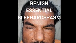 Benign essential blepharospasm BEB shorts [upl. by Reibaj]