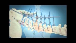 Scoliosis Surgical Correction with Instrumentation [upl. by Neomah405]