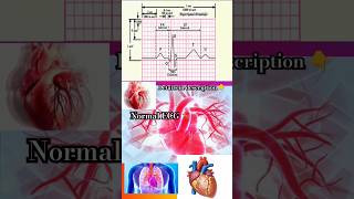 normal🫀ecg🫀heart🫀p QRS t Wave🫀heartattack🫀heart disease🫀viralshorts🫀yt shortsmbbsdoctor [upl. by Gottfried]