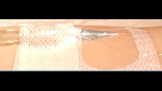 Peripheral IV Dressing Change Tegaderm™ IV Advanced [upl. by Ellerret410]