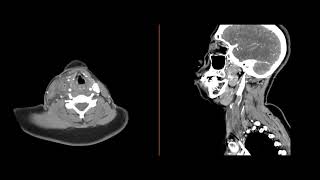 Internal jugular thrombophlebitis [upl. by Anilehcim]