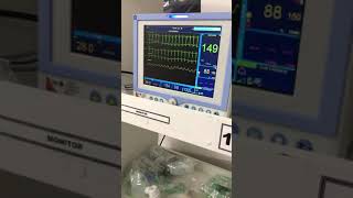 Taquicardia Sinusal em monitorização  Sinus tachycardia under monitoring [upl. by Boj]