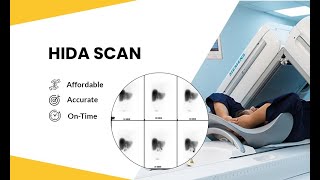 Bile Scintigraphy  Hepatobiliary Iminodiacetic acid Scan HIDA SCAN [upl. by Flaherty]