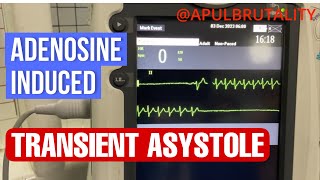 Adenosineinduced transient asystole during SVT treatment [upl. by Pinkerton]