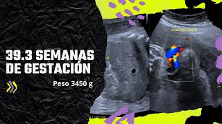 MI BEBÉ PESA 3450g TIENE YA 39 SEMANAS DE GESTACION  ES MACROSÓMICO [upl. by Hime]