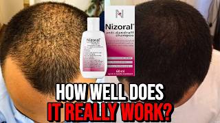 Ketoconazole Shampoo for Hair Growth  How Well Does it REALLY Work [upl. by Allain]