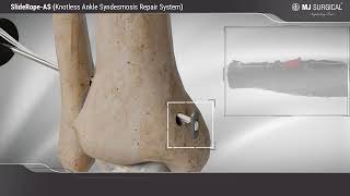 SlideRopeAS  Knotless Ankle Syndesmosis Repair System [upl. by Izak]